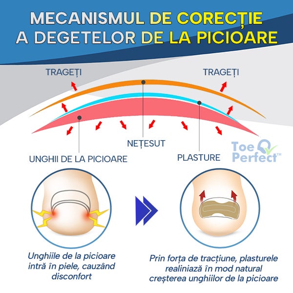 ToePerfect™ – Set 50 Plasturi Pentru Corectarea Unghiei Încarnate