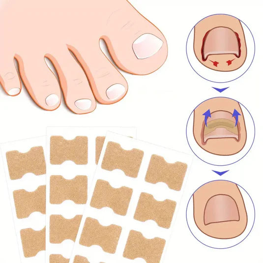 ToePerfect™ – Set 50 Plasturi Pentru Corectarea Unghiei Încarnate